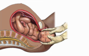 Normal Birth