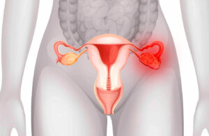 Myoma Uteri Nedir?