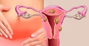 Myoma Uteri Nedir? 