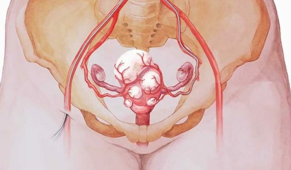 Myoma Uteri Treatment