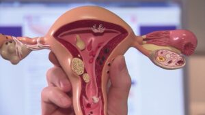 Myoma Uteri Treatment