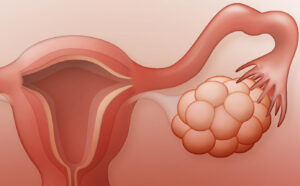What is an Ovarian Cyst in Women?