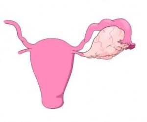 What is an Ovarian Cyst in Women?