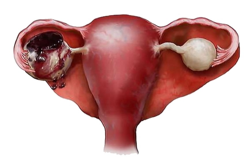 What is an Ovarian Cyst in Women?