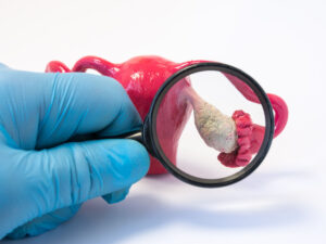 What is Polycystic Ovary Syndrome?