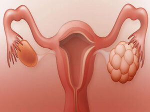 What is Polycystic Ovary Syndrome?