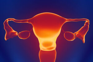 Ovarian Cancer