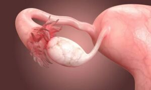 Ovarian Cyst Explosion