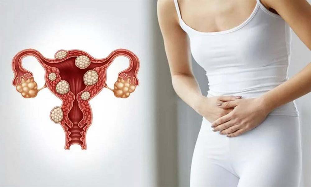 Myoma Uteri Ameliyatı