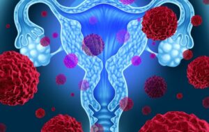Uterine Cancer