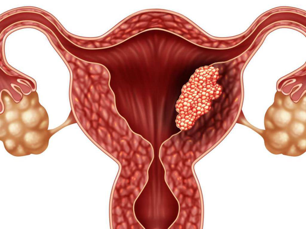 Uterine Tumor